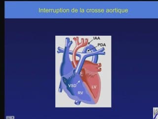 Le conotroncus et ses pathologies : Fallot, VDDI, DiGeorge, atrésie pulmonaire