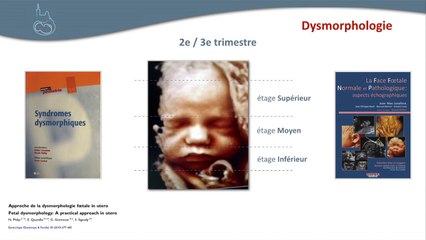 Retard de croissance intra utérin : bilan échographique d’un rciu non vasculaire échographique d’un rciu non vasculaire