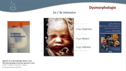 Retard de croissance intra utérin : bilan échographique d’un rciu non vasculaire échographique d’un rciu non vasculaire