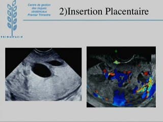 Place du 1er trimestre dans le dépistage des situations à risque du 3ème trimestre.