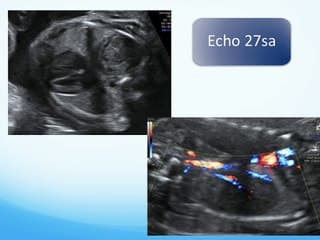 Association d’un rein droit intra-thoracique et d’une hernie de coupole diaphragmatique.