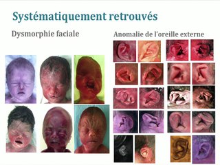 Le syndrome CHARGE : étude clinique etmoléculaire de 50 cas