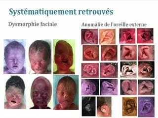 Le syndrome CHARGE : étude clinique etmoléculaire de 50 cas
