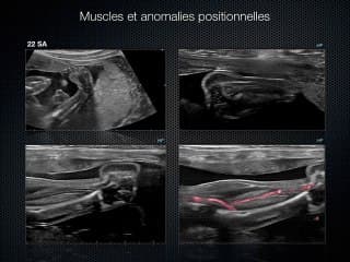 Apport des sondes à haute de_finition, échographie musculaire