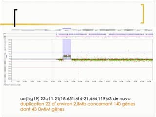 Dysgénésies du corps calleux Information anténatale et prise en charge pédiatrique.