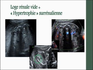 Méfions nous des ectopies rénales.
