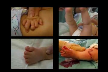 Prise en charge anténatale des anomalies des extrémités