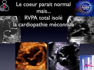 Retours Veineux Pulmonaires Anormaux