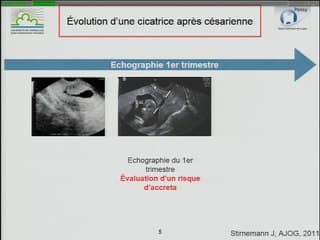 Imagerie des cicatrices utérines : Aux deuxième et troisième trimestres de la grossesse