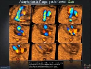 Échographie 3D des gros vaisseaux