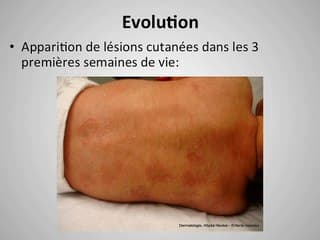 Cardiomyopathie foetale: pensez au lupus maternel :