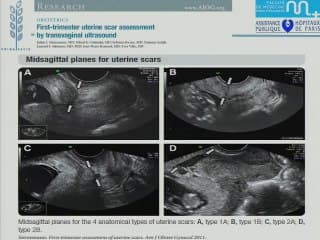 Échographie standardisée du segment inférieur au premier trimestre de la grossesse