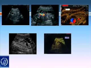 Anevrysme de la veine ombilicale