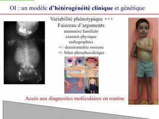 Maladies osseuses constitutionnelles : quels défis en 2019 ?
