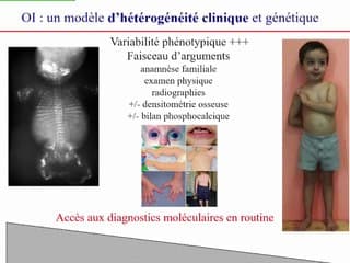 Maladies osseuses constitutionnelles : quels défis en 2019 ?