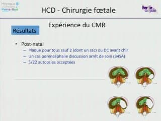 La technique FETO : bilan en 2013.