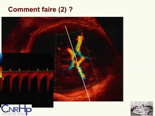 RCIU interet du pis systoliquede vélocité de l' artere cérébrale moyenne