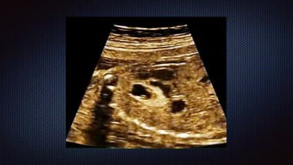 Staffs de dossiers : dossiers poumon ?Tératome du thymus ou sequestration ?