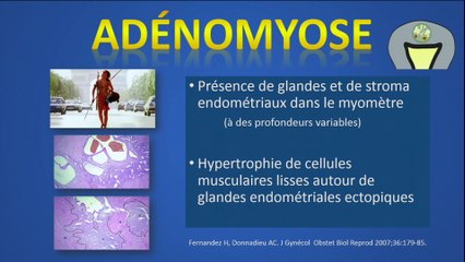 Imagerie nouvelle de l'adénomyose