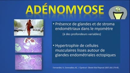 Imagerie nouvelle de l'adénomyose