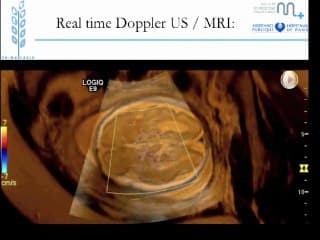 L'imagerie de fusion IRM - échographie dans l'exploration des malformations