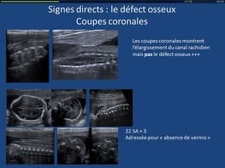 Diagnostic des myéloméningocèles, qu'attend-t-on de l'imagerie ?