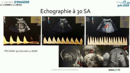 lymphangiome kystique géant