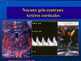 L’échographie trans fontanellaire chez le nouveau-né : aspects échographiques et étude doppler – indications