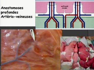 TAPS (Twin Anemia Polycythemia Sequence) : résultat de la prise en charge par laser au centre toulousain entre 2009 et 2014