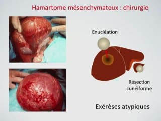 Tumeurs du foie foetal