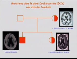 Les troubles de la gyration : le point de vue du neuropédiatre