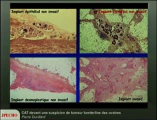 CAT devant une suspicion de tumeur borderline des ovaires