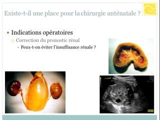 Existe-t-il une place pour la chirurgie anténatale ?