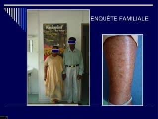 Chondrodysplasie ponctuée liée à l' X