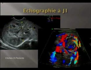 Hemangiome hépatique