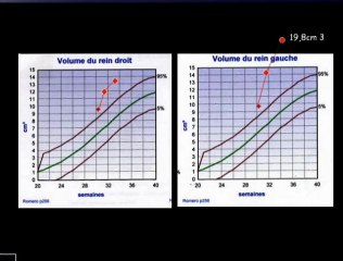 Diurese foetale
