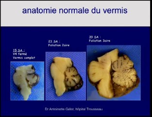 aspect antenatal de la fosse post