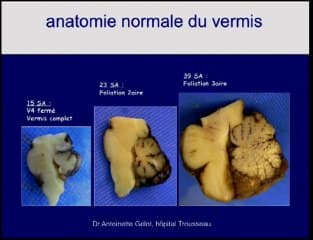 aspect antenatal de la fosse post