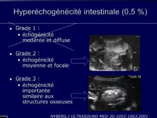 Quand demander un caryotype foetal devant un signe échographique au 2eme trimestre ? Anomalies funiculaires et du placenta,Nuque au 2ème trimestre ,