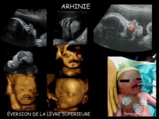 Modification du relief nasal : Binder ou ...?