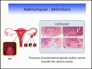 Adénomyose, découverte et conséquences