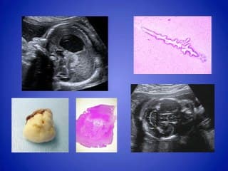 Dilatations ventriculaires