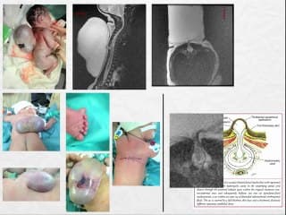 Devant un myéloméningocèle, quelles informations dois-je transmettre au neurochirurgien ?