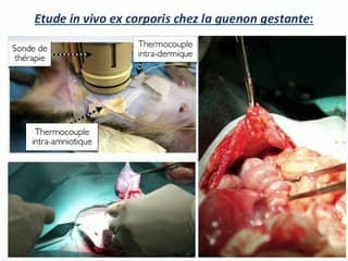 Quel avenir pour l'HIFU en médecine foetale