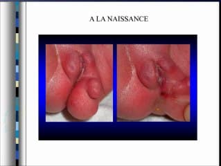 Mésenchymome bénin du périné