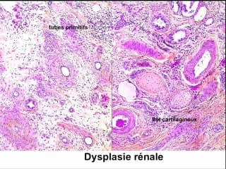 Apport de la foetopathologie en cas d'IMG