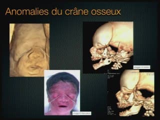 Apport de l'échographie volumique pour le diagnostic et le pronostic des dysplasies oto-mandibulaires