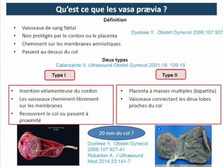 ÉCHOGRAPHIE EN SALLE DE TRAVAIL Vasa prævia
