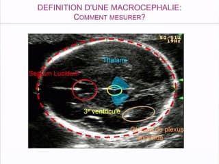 macrocrânie : imagerie, syndromes*