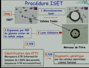 Mucoviscidose : cellules foetales sur sang maternel et / ou biopsie de trophoblaste